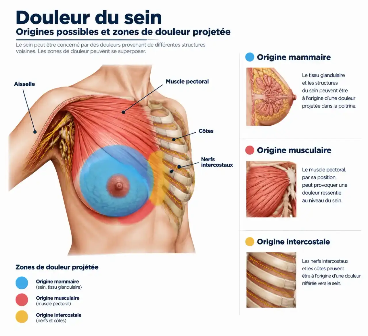 Schéma des causes possibles d'une douleur au sein et des zones de douleur projetée
